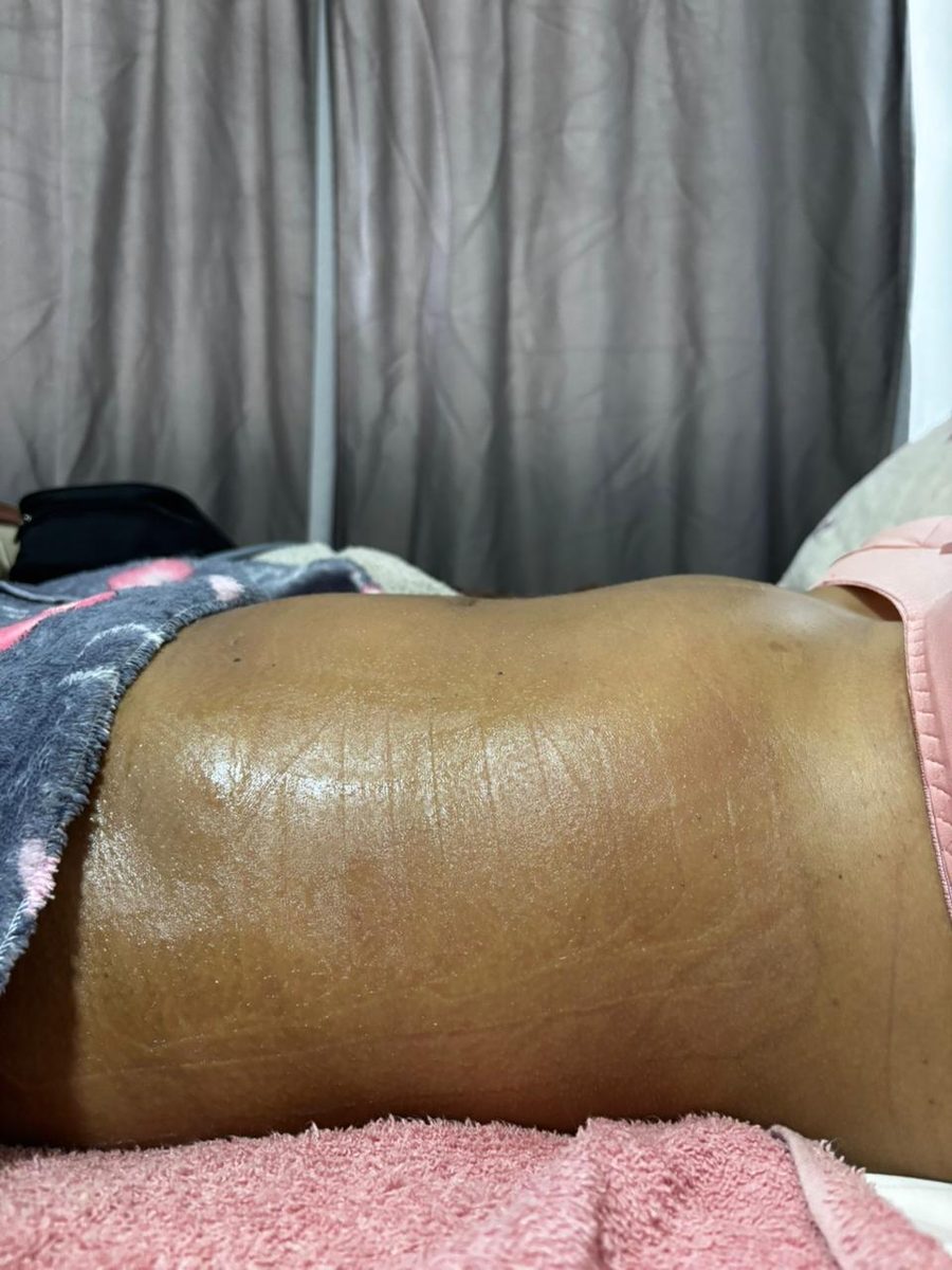 Resultado da bandagem de taping pós-parto